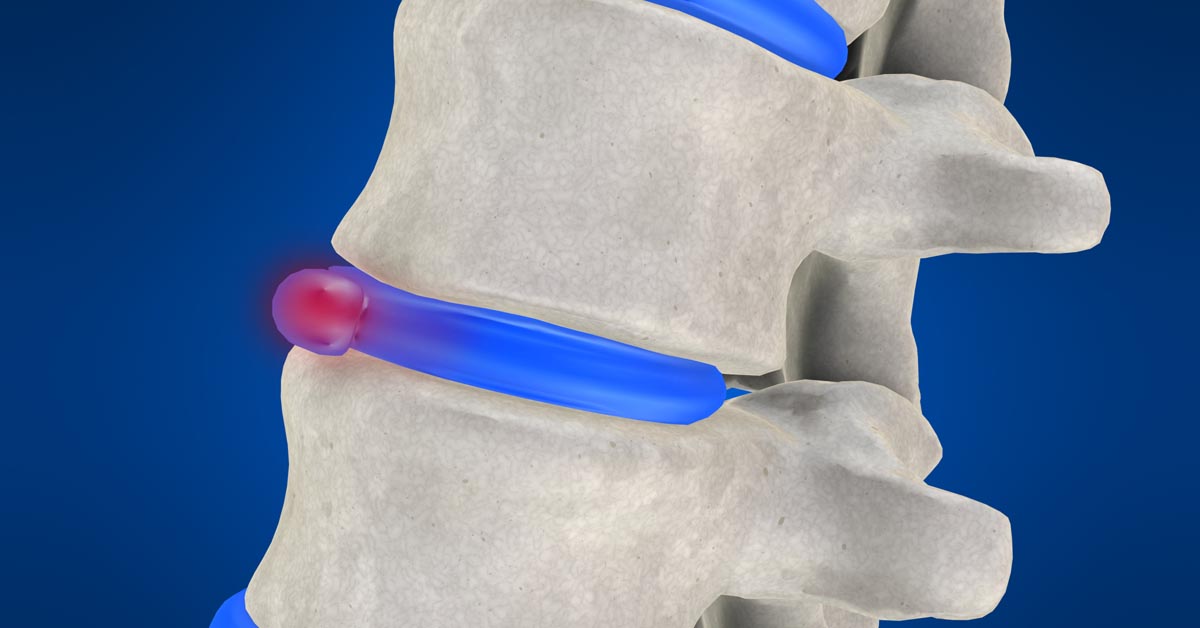 Rutland non-surgical disc herniation treatment