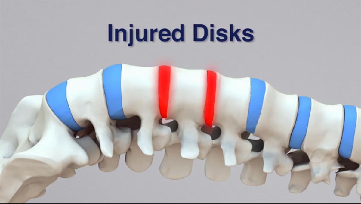 Rutland non-surgical spinal decompression